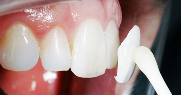 Những trường hợp nào nên dán răng sứ veneer?