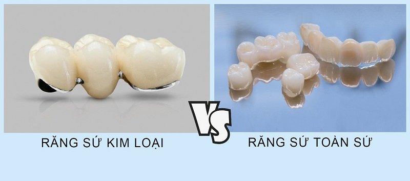 Răng sứ kim loại và răng sứ toàn sứ là 02 dòng răng sứ thông dụng nhất hiện nay