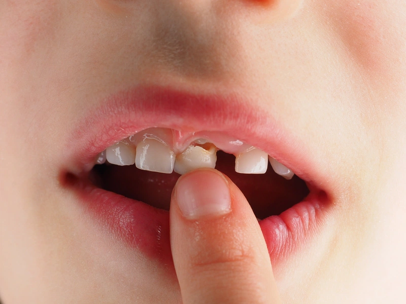 Cách nhổ răng sữa không đau và chăm sóc sau khi nhổ răng cho bé - Nhà thuốc FPT Long Châu